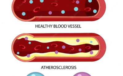 Cholesterol-How It Impacts Your Heart
